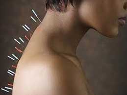 acupuncture